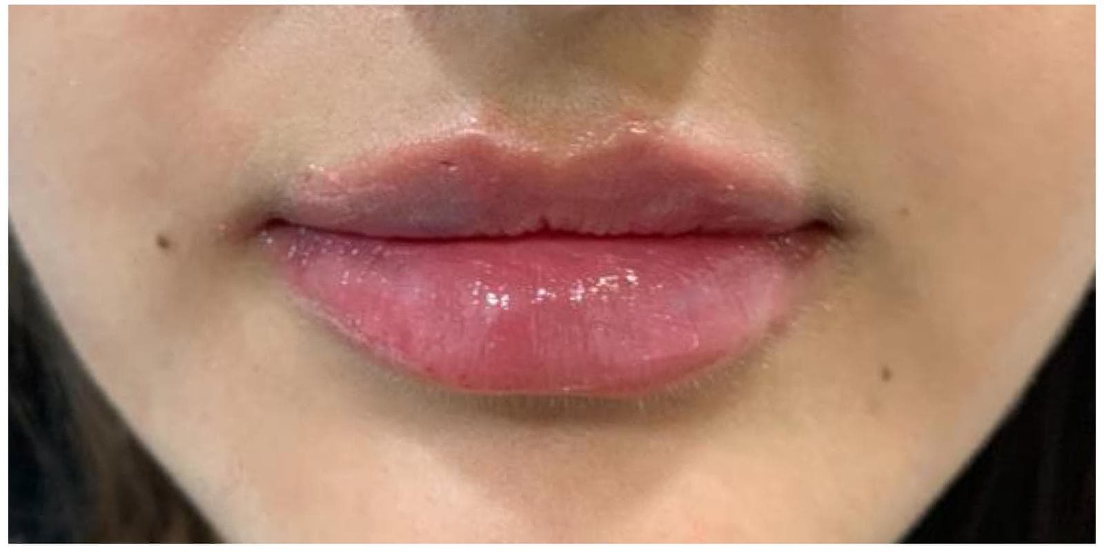 Lip Fillers after