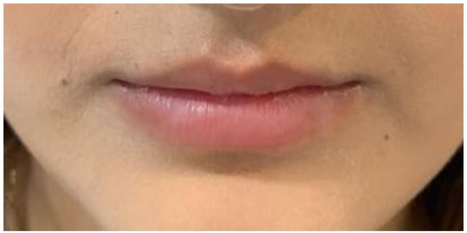 Lip Fillers before