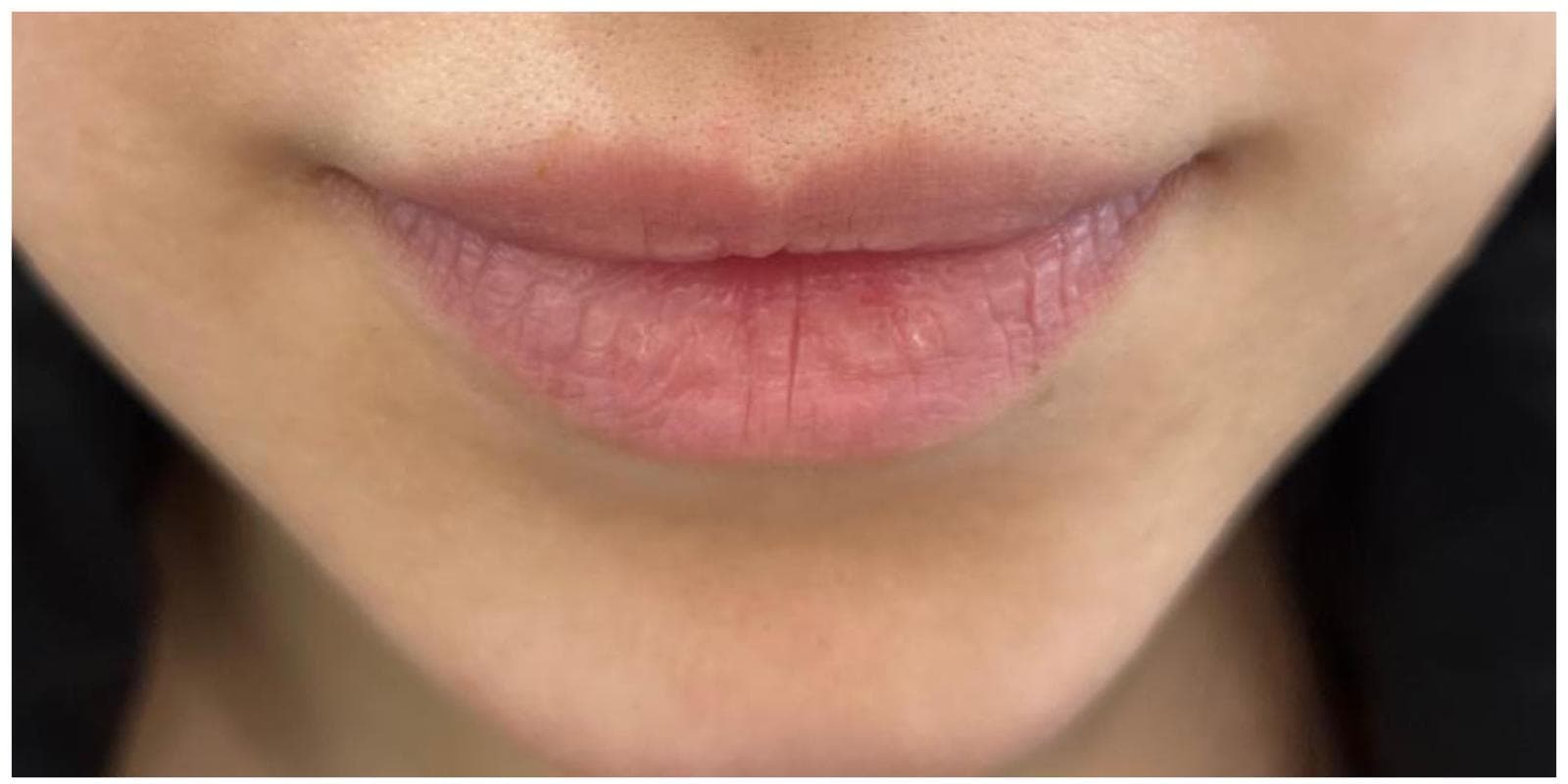 Lip Fillers before