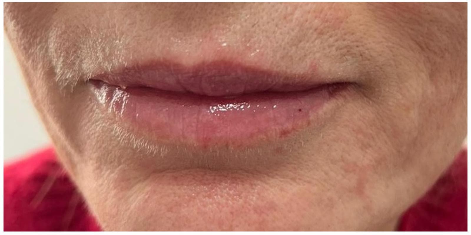 Lip Fillers after