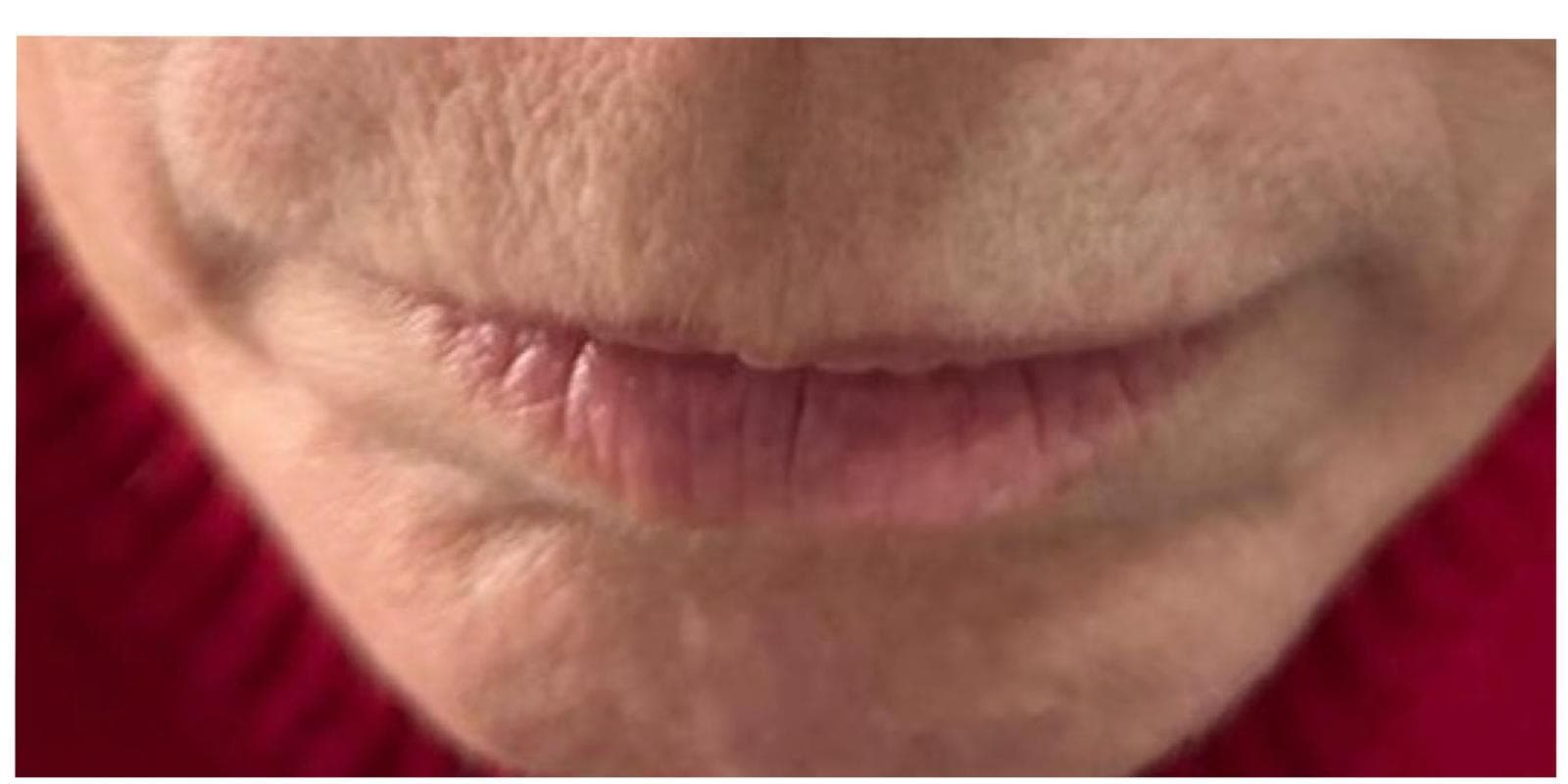 Lip Fillers before